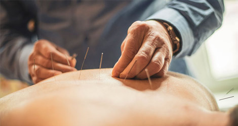 Acupuncture